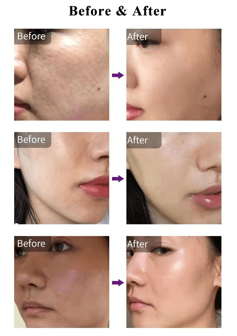 dermashine before after